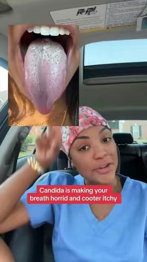 Im so glad they put me on to this cleanse i was always so embarrassed by my tounge #candida #gyn #internship #resultsmayvary 